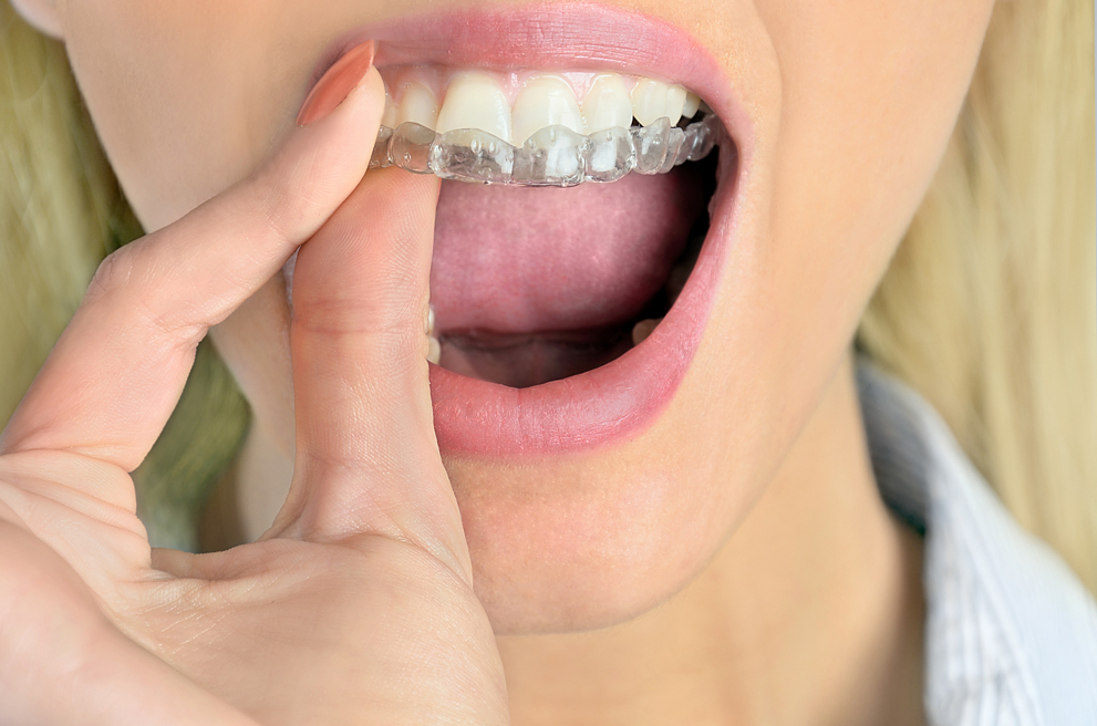 Woman putting on a nightguard to protect her teeth while she sleeps