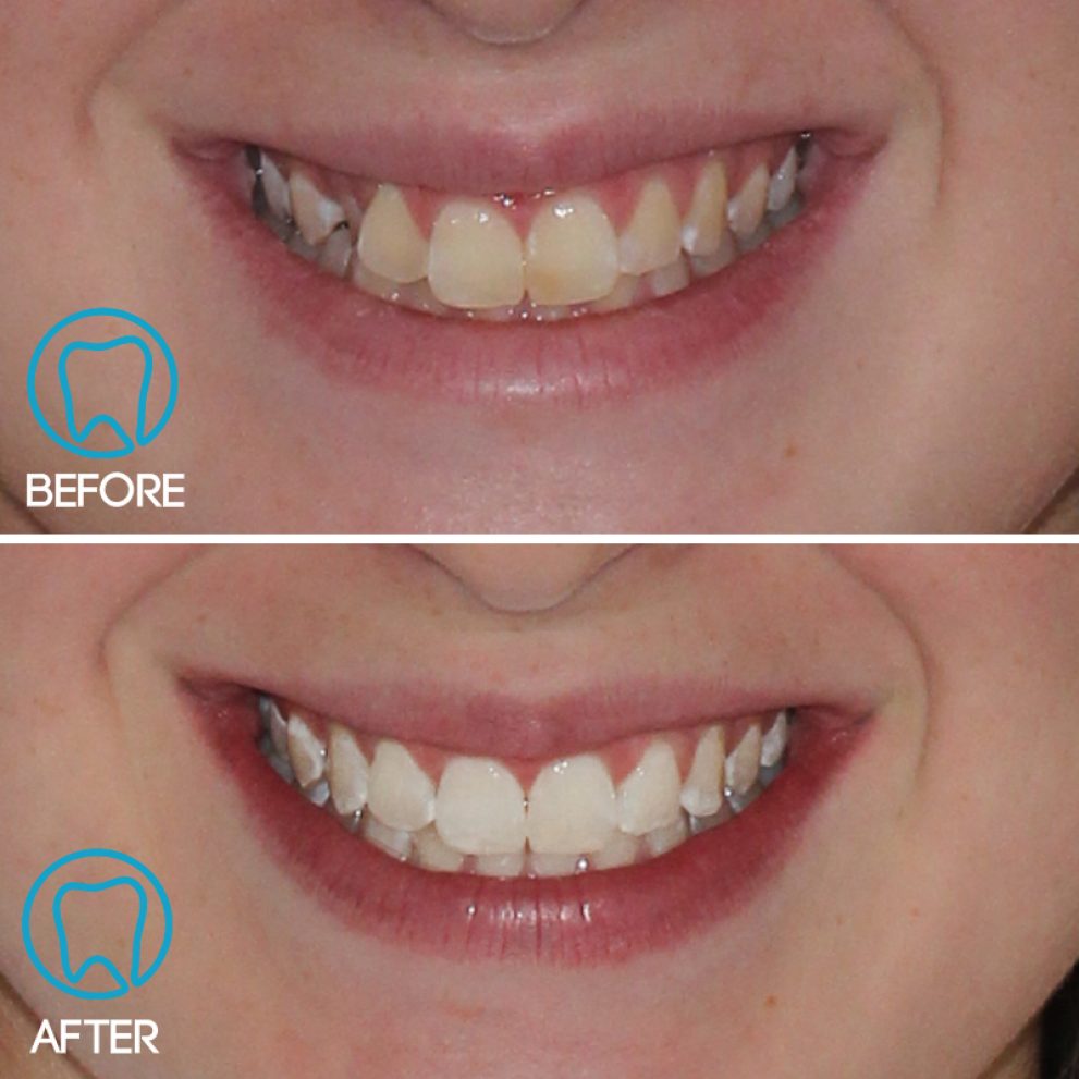Invisalign After Braces in NYC - Cosmetic, General and Pediatric Dentistry  located in the heart of NYC.