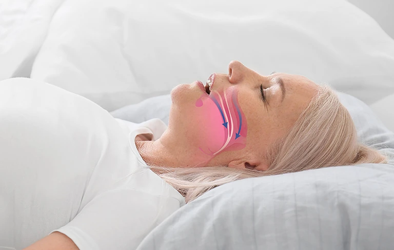Sleep Apnea Health Breathing Airways