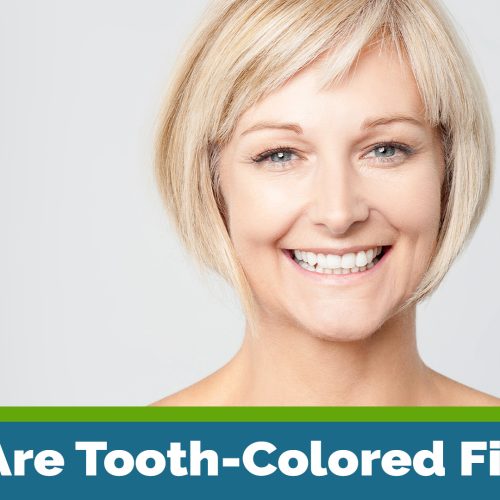 What Are Tooth-Colored Fillings? (featured image)